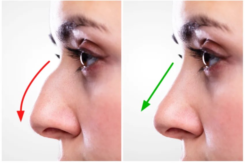 راهنمای مراقبت بعد از رینوپلاستی: از روز اول تا بهبودی کامل
